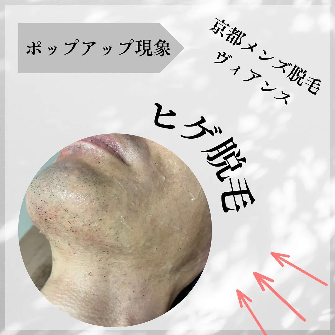 ヒゲ脱毛照射後