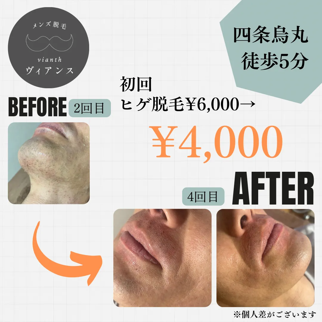 ヒゲ脱毛4回目