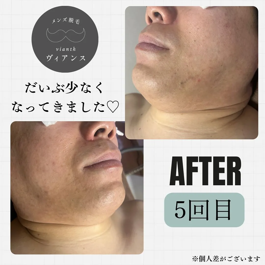 ヒゲ脱毛5回目