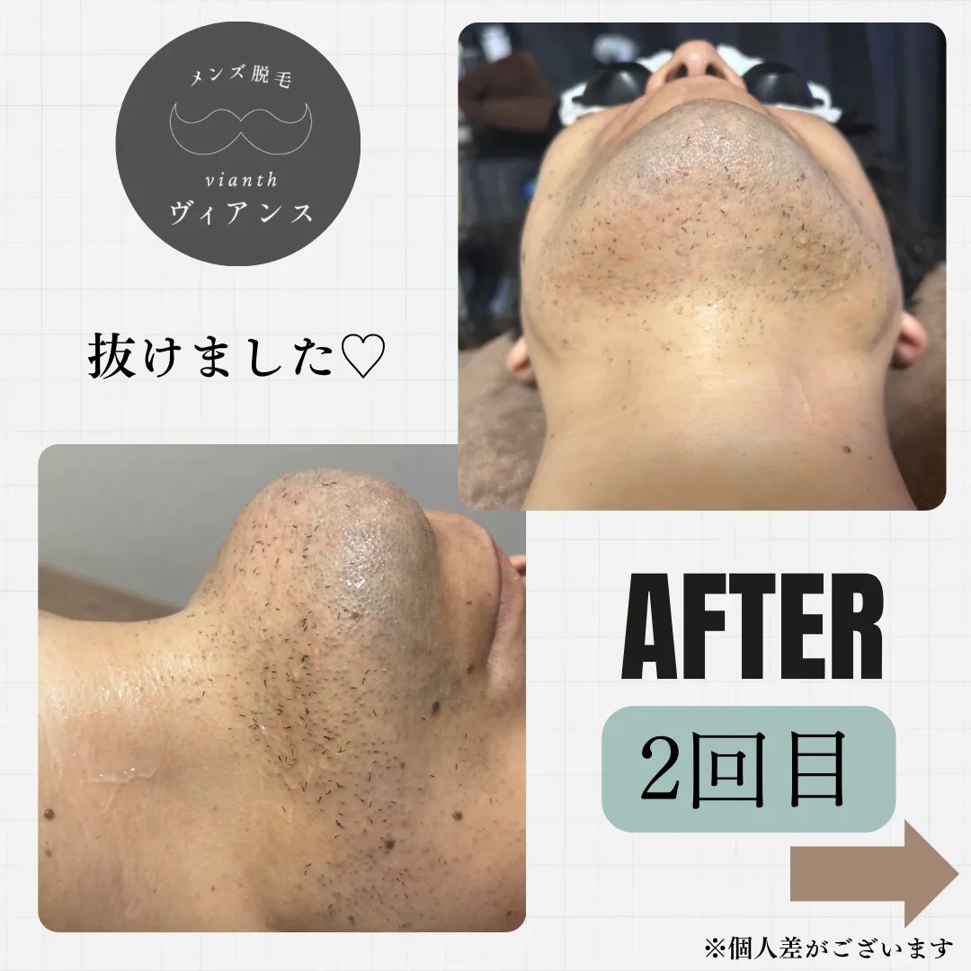 ヒゲ脱毛2回目